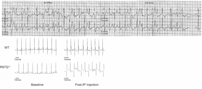 Graphs of patient and mouse tachycardia