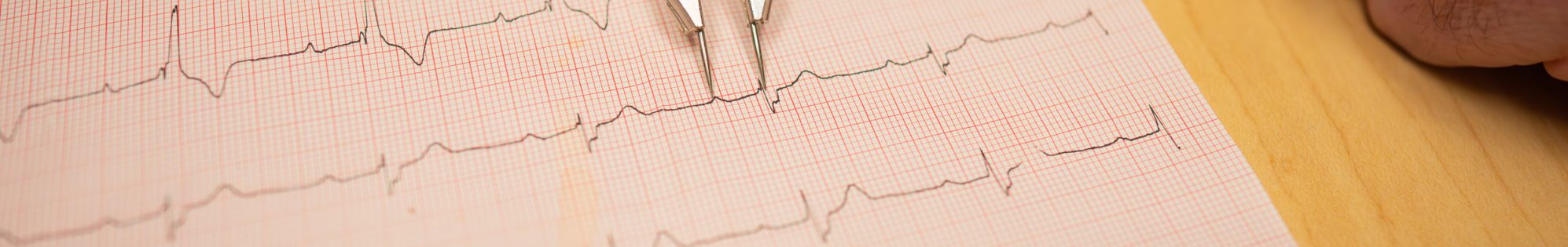 Chart of a sinus rhythm.