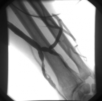 Interventional Nephrology