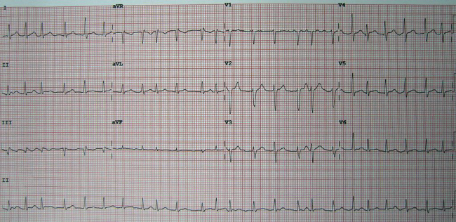 Atrial fibrillation EKG