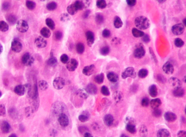 Micrograph (H&amp;amp;E stain) of a plasmacytoma