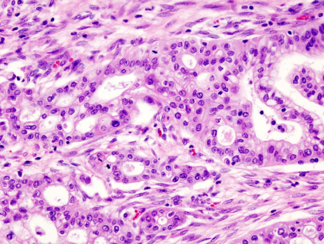 pancreatic adenocarcinoma