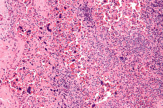 systemic lupus erythematosus