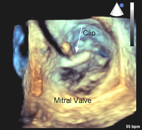 Multidisciplinary Team Performs Minimally-Invasive Transcatheter Mitral Valve Repair