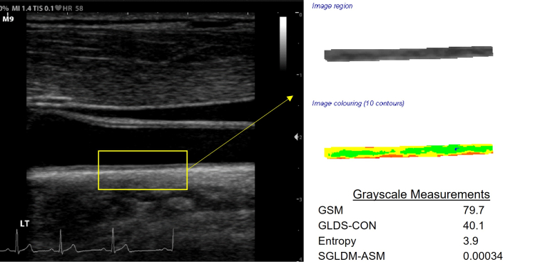 Gray ultrasound of the distal common carotid artery with far wall extraction, color coding of grayscale, and grayscale measurements of early arterial injury