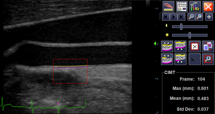 image of carotid artery intima-media thickness (IMT) tracing