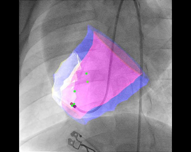 photo of 3D image fusion model for transendocardial injections