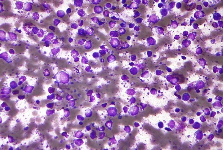Micrograph of a diffuse large B cell lymphoma