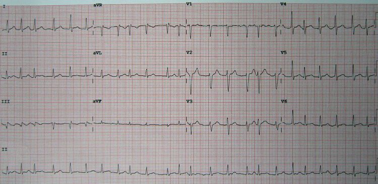 Atrial fibrillation EKG