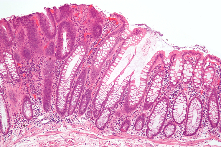 colorectal cancer micrograph