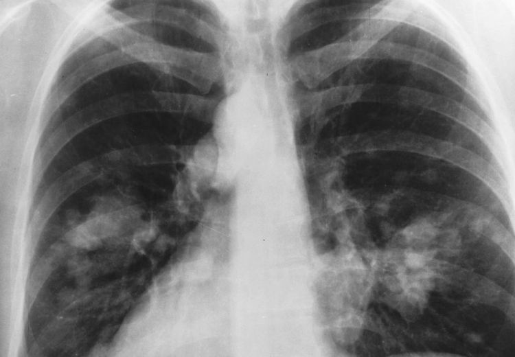 lung x-ray