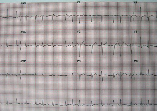Atrial fibrillation EKG
