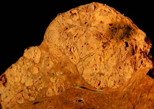 Hepatocellular carcinoma