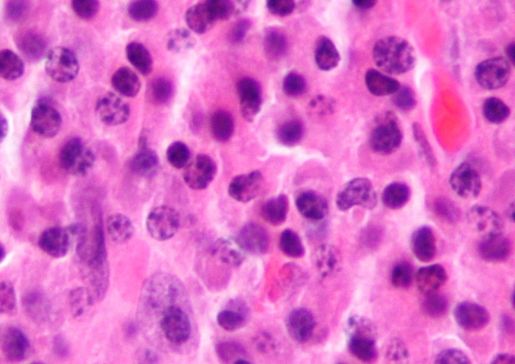 Micrograph (H&amp;amp;E stain) of a plasmacytoma