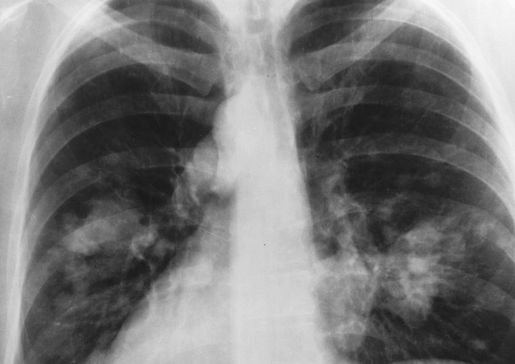 lung x-ray