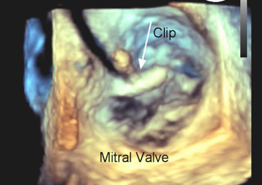 Multidisciplinary Team Performs Minimally-Invasive Transcatheter Mitral Valve Repair