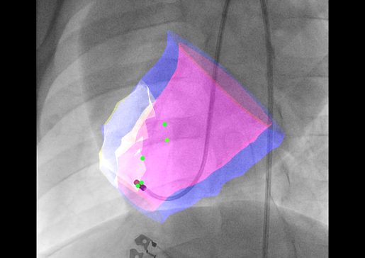 image of 3D image fusion model for transendocardial injections
